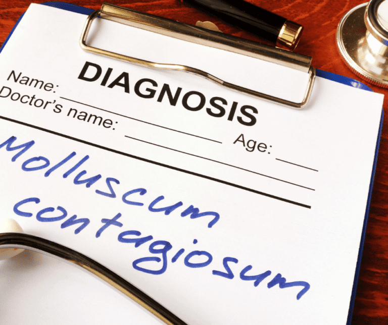 How to get rid of Molluscum Contagiosum for good HealthPrimitive